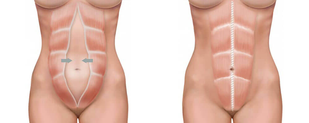 diastasis_de_los_rectos