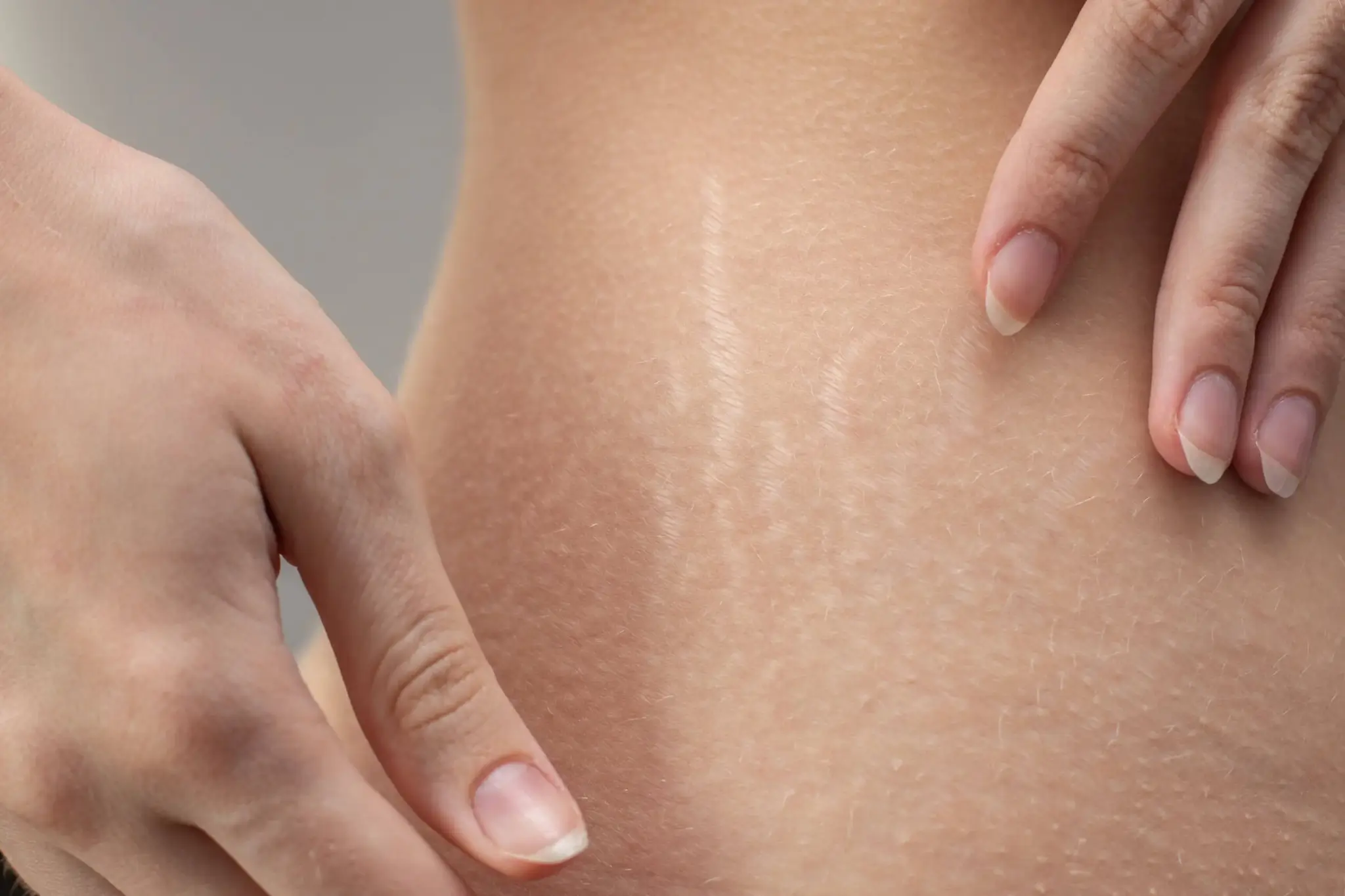 estrias-manos-cuerpo.jpg
