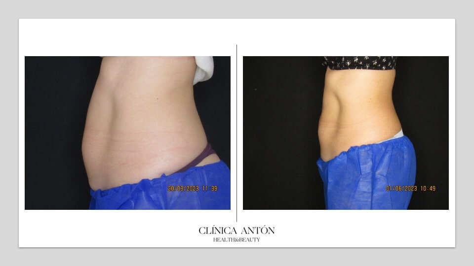 Coolsculpting results